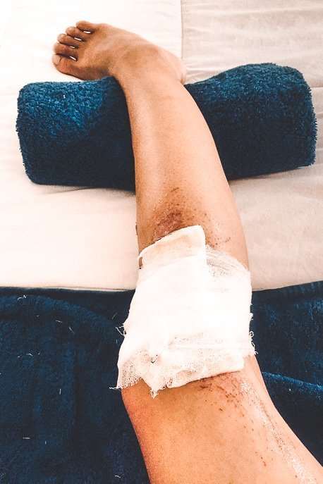 Why You Should Not Rent A Scooter In Nusa Penida 10 P Jasmine's injured right knee bandaged up after falling off the scooter in Nusa Penida