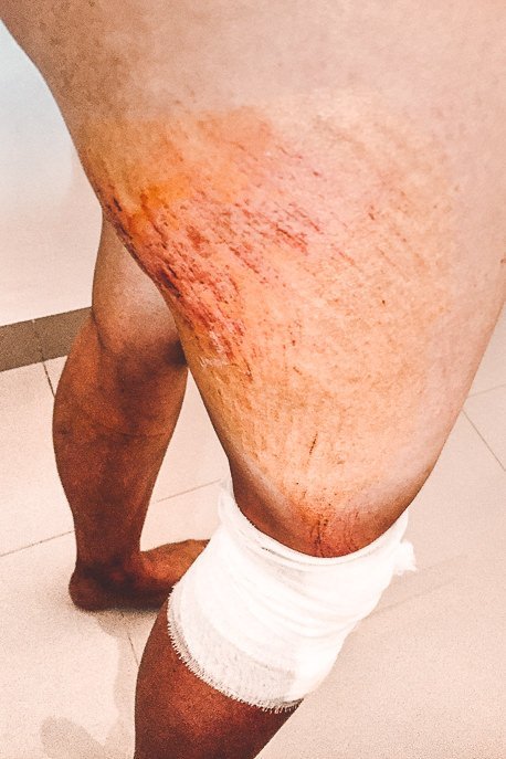 The injuries on Jasmine's right thigh from falling off the scooter in Nusa Penida